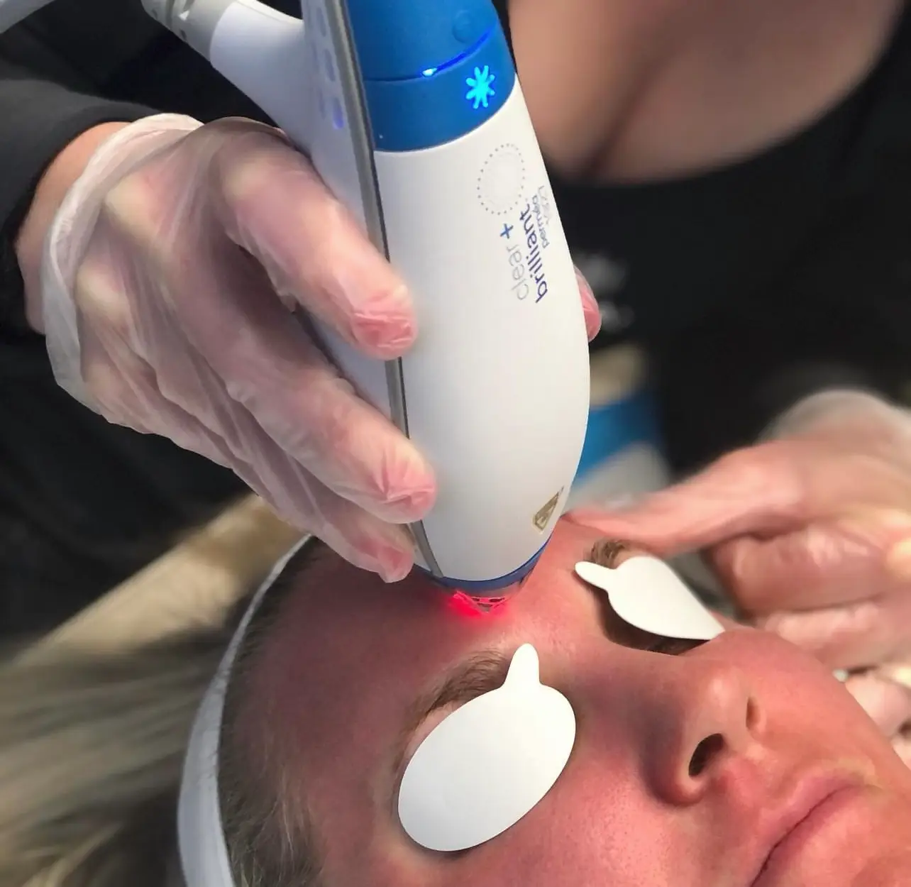 Clear Brilliant Laser in Northglenn, CO | Uptown Aesthetics