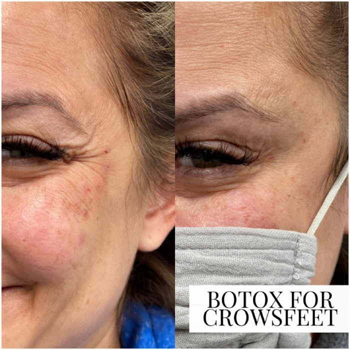 Uptown Medical Aesthetics Concern Crows Feet Before After Image in Northglenn, CO