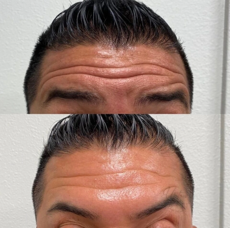 Uptown Medical Aesthetics Concern Forehead Wrinkles Before After Image A in Northglenn, CO