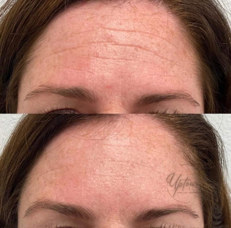 Uptown Medical Aesthetics Concern Forehead Wrinkles Before After Image B in Northglenn, CO