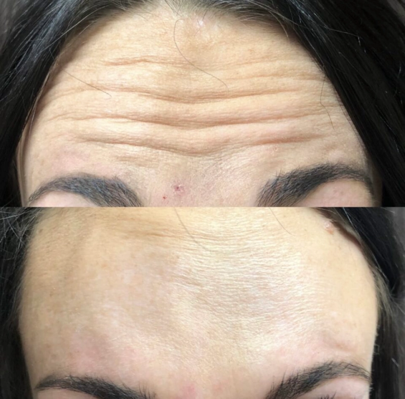 Uptown Medical Aesthetics Concern Forehead Wrinkles Before After Image C in Northglenn, CO