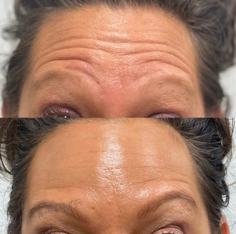 Uptown Medical Aesthetics Concern Forehead Wrinkles Before After Image D in Northglenn, CO