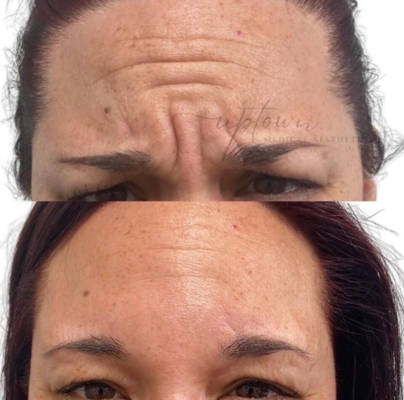 Uptown Medical Aesthetics Concern Frown Lines Before After Image B in Northglenn, CO