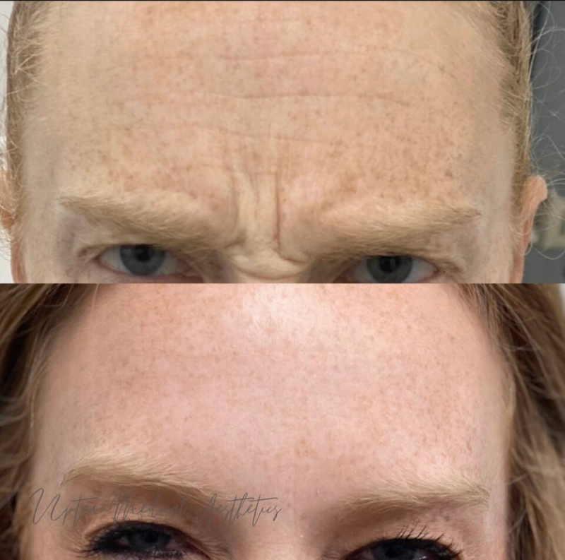 Uptown Medical Aesthetics Concern Frown Lines Before After Image C in Northglenn, CO