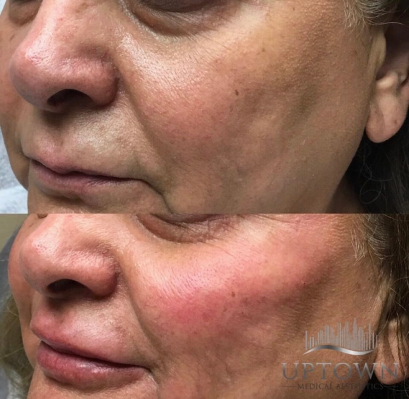 Uptown Medical Aesthetics Concern Hollow Cheeks Before After Image in Northglenn, CO