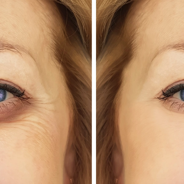 Uptown Medical Aesthetics Concern Hollow Eyes Before After Image A in Northglenn, CO