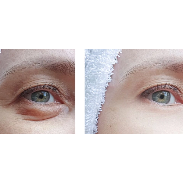 Uptown Medical Aesthetics Concern Hollow Eyes Before_After Image B in Northglenn, CO