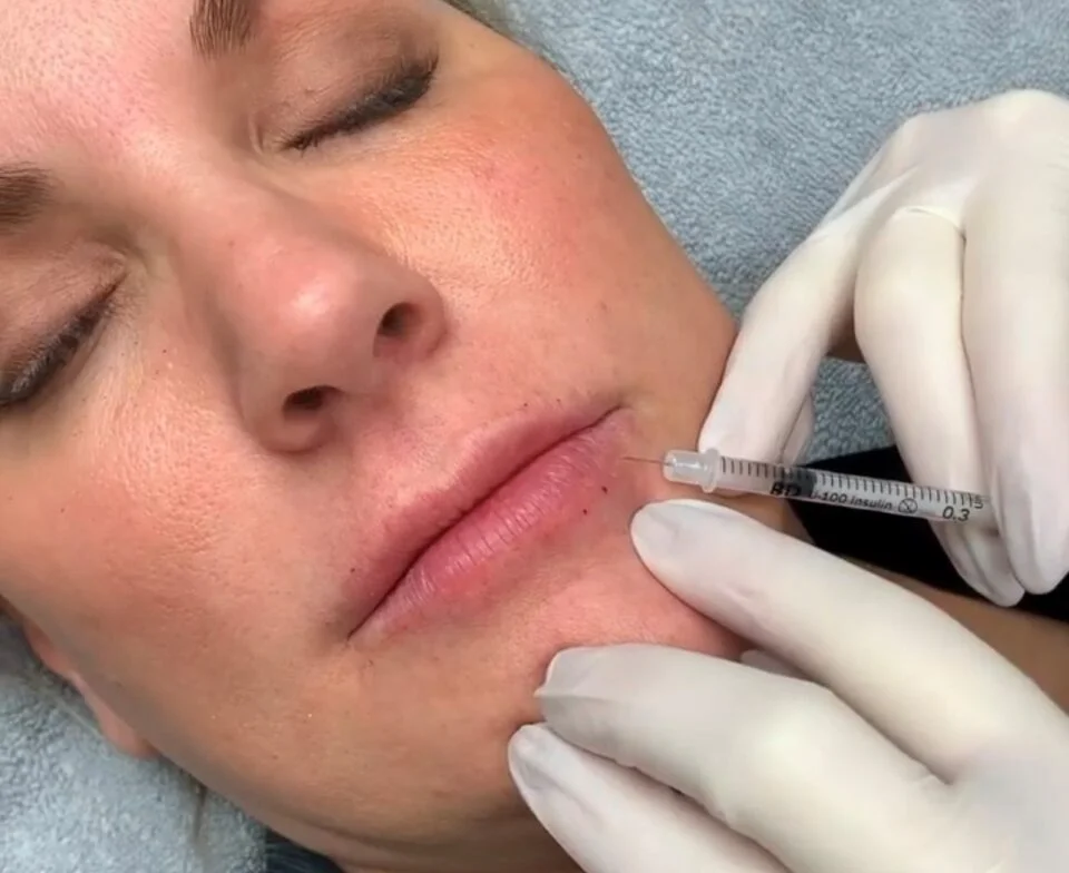 Lip Filler Injection in Northglenn, CO | Uptown Medical