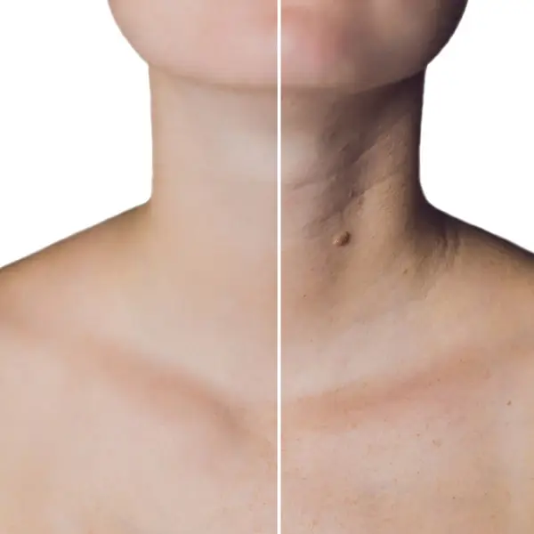 Uptown-Medical-Aesthetics-Concern-NECK-NECKLACE-LINES-Before-After-Image-A-in-Northglenn-CO