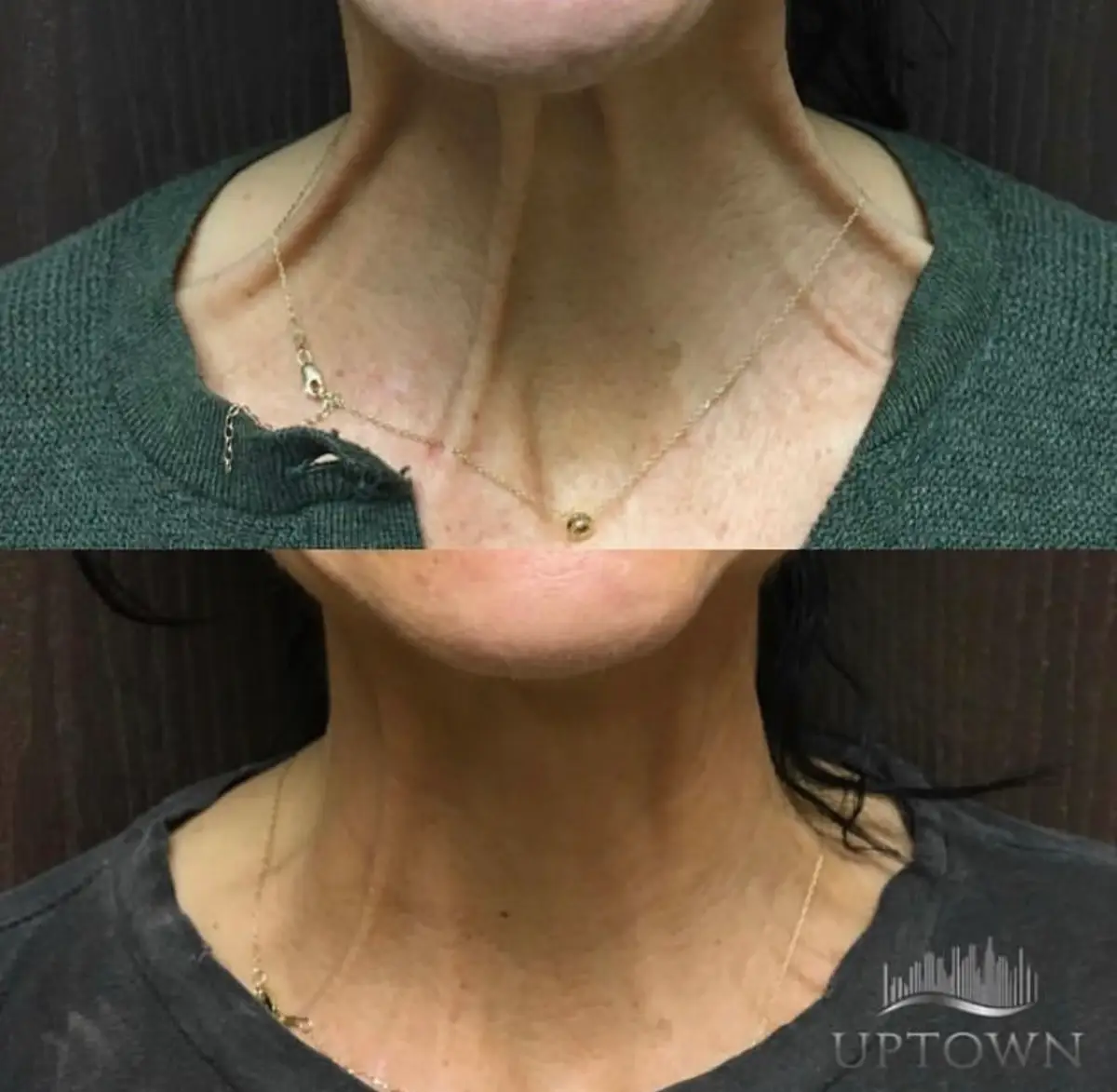 Uptown-Medical-Aesthetics-Concern-NECK-NECKLACE-LINES-Before-After-Image-B-in-Northglenn-CO