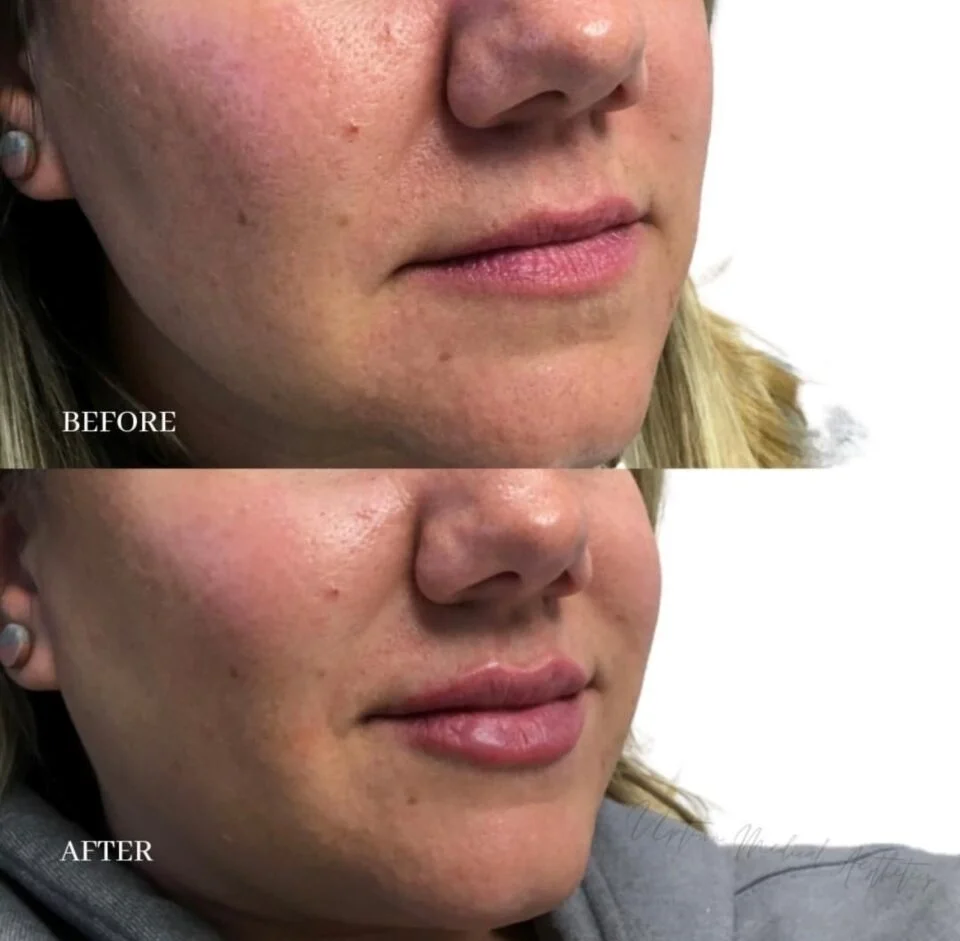 Uptown Medical Aesthetics Concern lip filler Before After Image a in Northglenn, CO