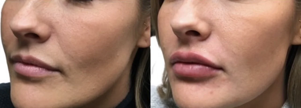 Uptown Medical Aesthetics Concern lip filler Before After Image b in Northglenn, CO