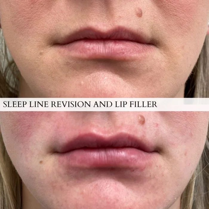 Uptown Medical Aesthetics Concern lip filler Before After Image c in Northglenn, CO