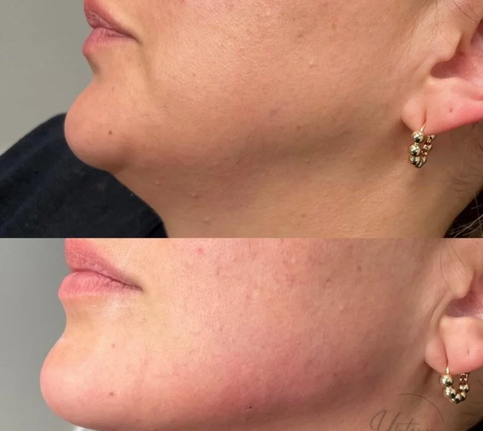 Uptown Medical Aesthetics Jawa filler Before After Image c in Northglenn, CO