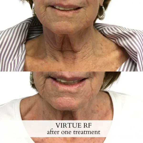 Uptown-Medical-Aesthetics-Virtue-RF-Before-After-Image_B-in-Northglenn-CO