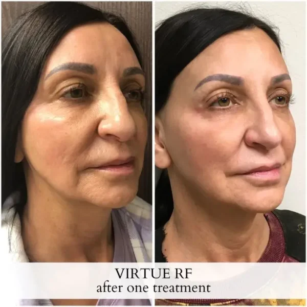 Uptown-Medical-Aesthetics-Virtue-RF-Before-After-Image_C-in-Northglenn-CO